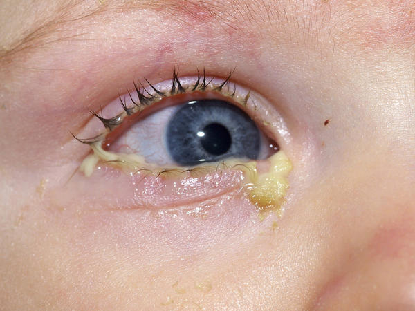 conjuntivitis